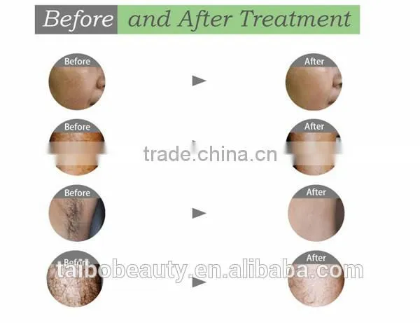 Distributors for Ireland Permanent Hair Remove Machine / Ipl Alex Laser Shr Hair Removal photo-4