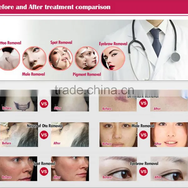 High Quality Professional Tattoo Removal Q-switch Laser photo-6