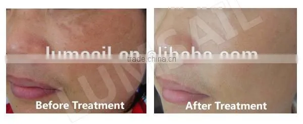 Face Mask Led the Lamp Facial Muscle Stimulator Red Light Therapy Beauty Equipment photo-5