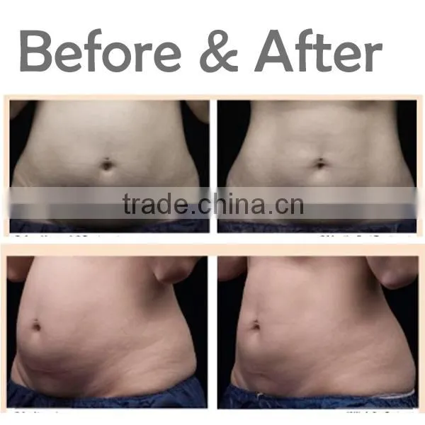 2016 Effective Weight Loss Body Shaping 8mm 13mm HIFU Body Slimming Machine photo-5