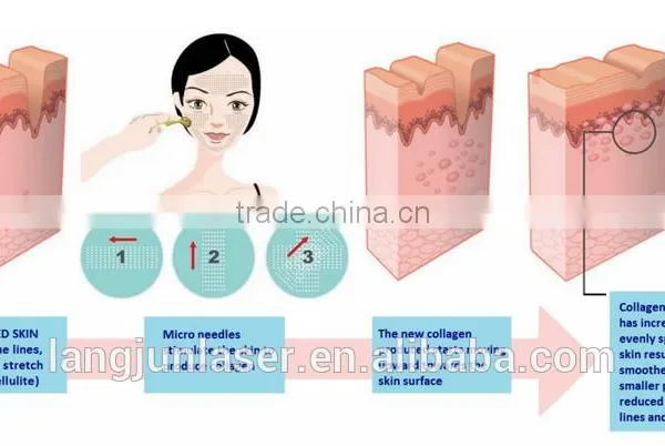 Proffesional 540 Needles Stainess Steel and Titanium Derma Roller photo-6