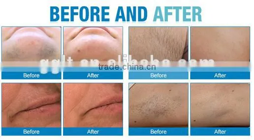 Sapphire Laser Diode 808nm Machine Painless for Permanent Hair Removal photo-5