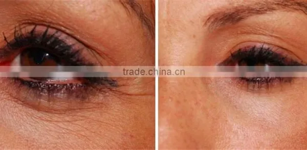 2015 rf Eyes Care Salon Portable Machine photo-5