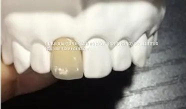 Dental Pfm Crown From China Dental Lab photo-3