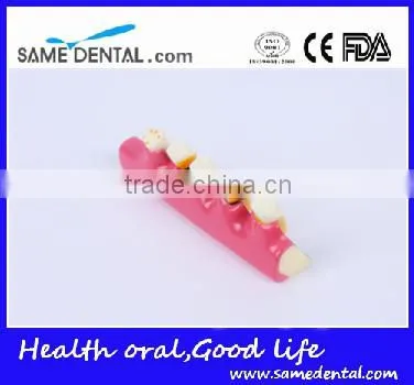 2x Periodontal Disease Classification Models Dental Eduction Assitant No. DEA-20 photo-2