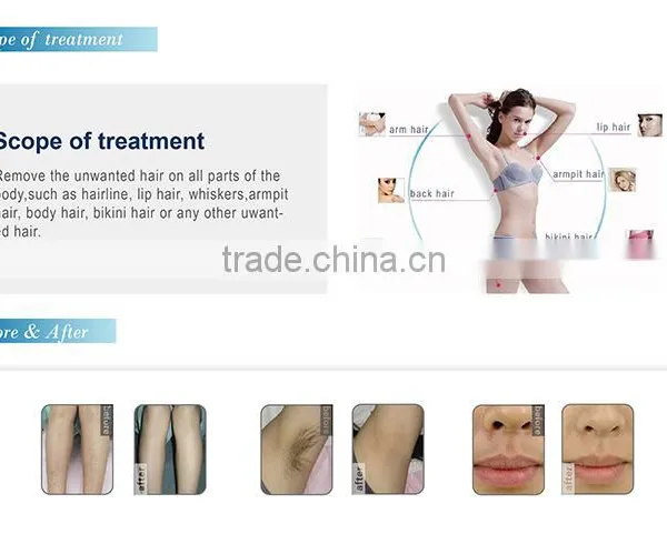 Best Painless and Permanent Depilator Professional 808 Diode Laser Hair Removal Machine photo-4
