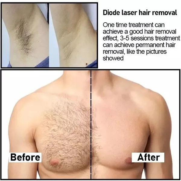 ADM Four Wavelengths Diode Laser Beauty Machine for All Skin Types 755 808 940 1064nm Diode Laser Hair Removal Machine photo-4