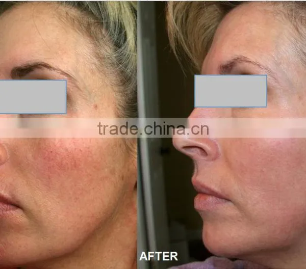 Beautician Use Nd Yag Laser Tattoo Removal Laser for Sale photo-6