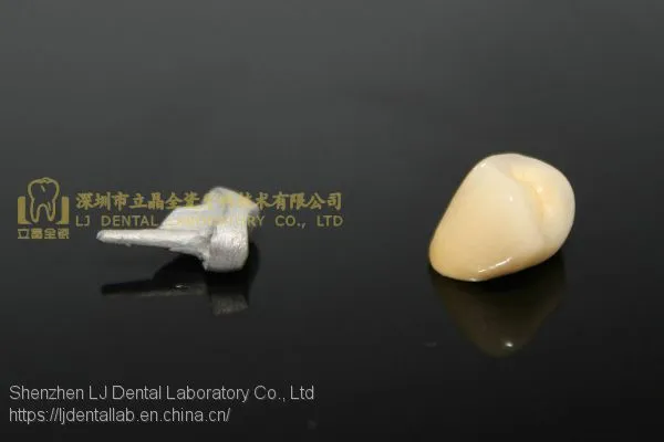 Full Metal Post Core, Full Ceramic Post Core, Richmond Crown, Cast Metal Crown, Dental Prostheses, Laboratorio Dental, Dental Laboratory, Dentallabor, LJ Dental Lab China photo-4