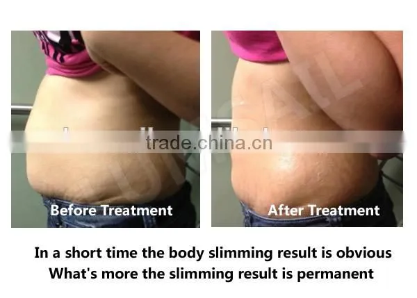 Liposuction Equipment Cosmetic Surgery Liposuction Equipment High Quality Plastic Surgery Equipment photo-5