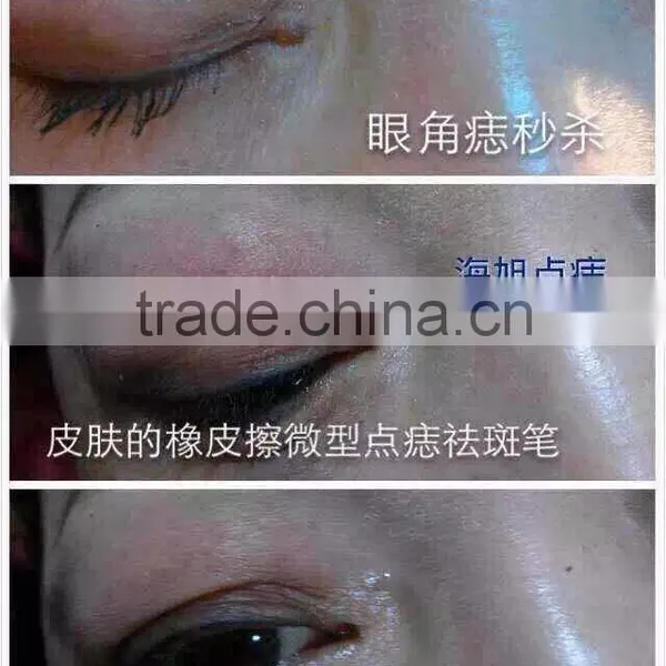 Spot Removal Machine , Freckle Removal Machine $260/pcs ,without Shipping photo-4
