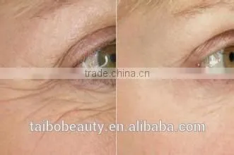 Fractional rf Micro Needling Dark Spot Removal Machine From Beauty Salon Equipment Supplier photo-3