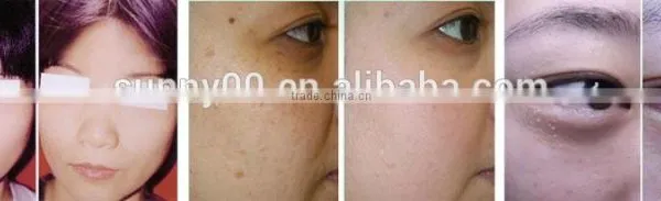 Benign Familial Pemphigus Treatment Laser Machine/co2 Laser Machine for Surgical photo-4