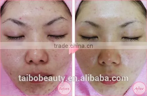 Best Dermabrasion Peeling Machine for Reduce Oily Skin Microderbrasion Peeling Machine photo-6