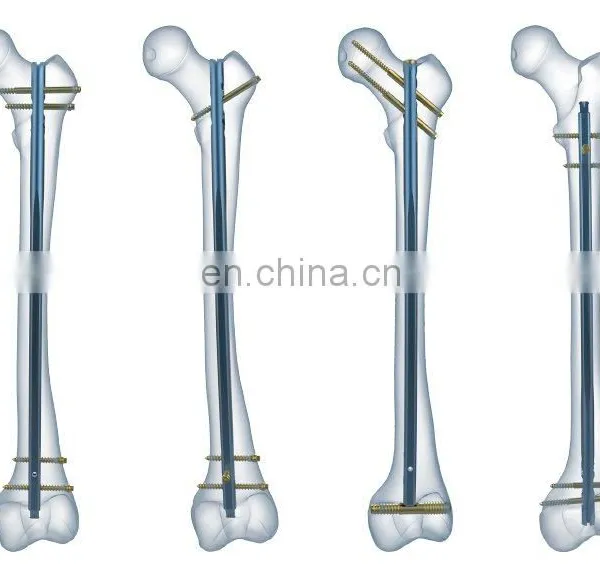 Humerus Interlocking Nail photo-3