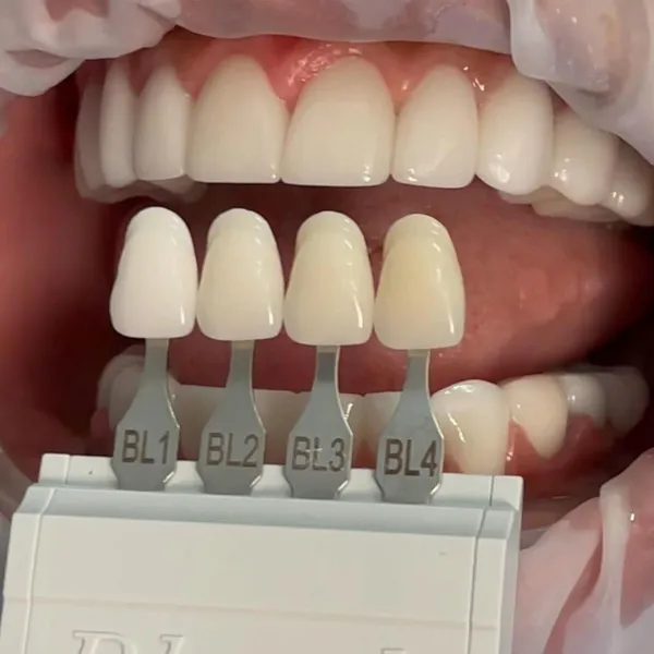 Dental Clip On Veneers, Snap On Veneers, Smile Veneers, Laboratoire Dentaire, Dentallabor,Dental Lab photo-3