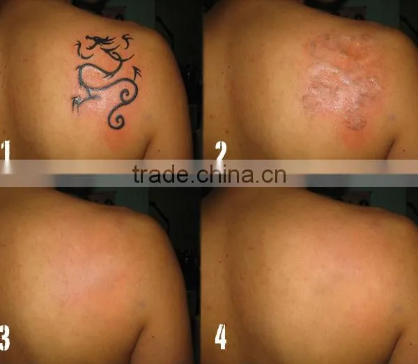 Varicose Veins Treatment Promotion!!!!ND:YAG Tattoo Removal 1 HZ Laser Machine For Beauty & Personnal Care Tattoo Removal Laser Machine photo-6