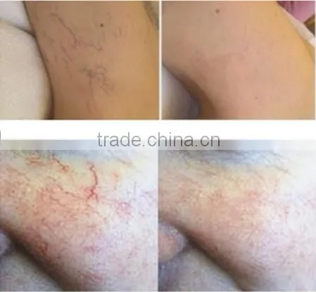 Laser Beauty Equipment SDL-G Model 980nm Diode Laser Vascular Removal photo-6