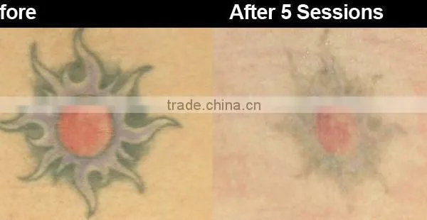Hot Sale Q Switched Nd Yag Laser Tattoo 800mj Removal Nd Yag Laser Tattoo Removal Machine 1064nm photo-5