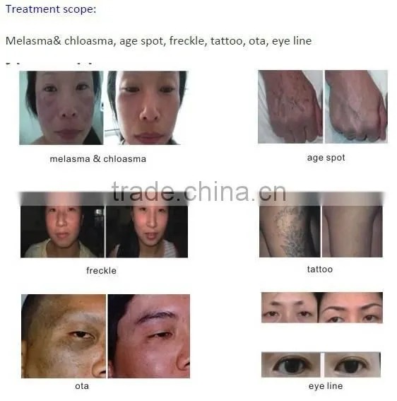 Beauty Mini C6 High Energy ND YAG Laser Spot Removal /tatoo Removal/ Skin Pigmentation Treatment With Q -switch Tatoo Removal photo-5