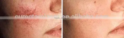 Hot Sale New Year Spider Veins/ Spider Vein Laser/ Spider Vein Removal Machine photo-5