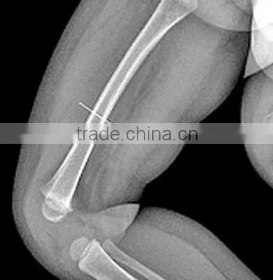 Medical Thermal x Ray Film,medical Consumable Item ,medical Surgical Consumables