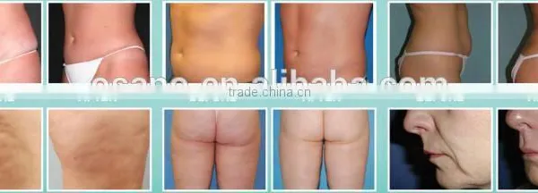 We Need Distributors 4 Handles OSANO Body Shape Vaser Liposuction Machine For Sale photo-6