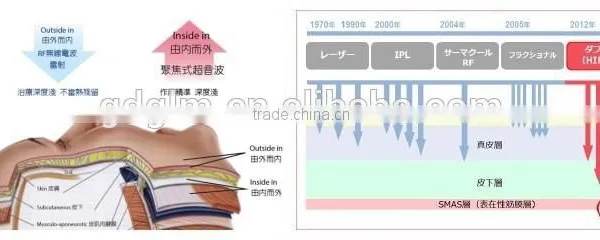 2016 GLM HOT SALE!hifu Machine/ultrasound Hifu For Wrinkle Chest Shaping Removal /F-029 Hifu Face Lift For Sell 1.0-10mm photo-4