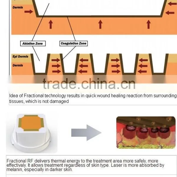 New Style Mini Bipolar Radio Frequency Wrinkle Removal Machine With Microneedle and Fractional Heads photo-4
