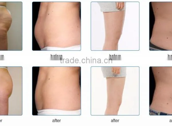 CoolPlas SCV-102 3 Cryo Applicators Best Effect Cryo Fat Freezing Machine For Sale photo-5