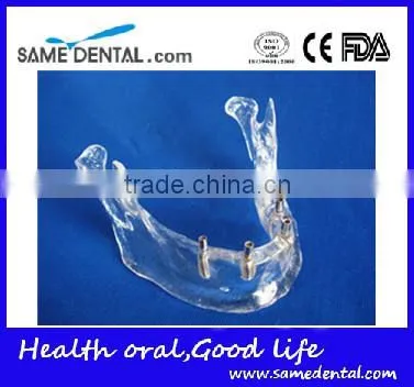 Hot Sale Transparant Mandibule Implant Model photo-2