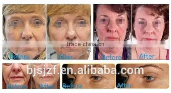 Anybeauty With 7 Treatment Heads Portable HIFU-C Hifu Ultra Face Lift photo-5