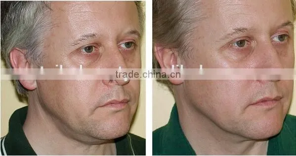 rf Age Spot Removal rf Facial Machine/intracel Fractional rf Microneedle Machine photo-6