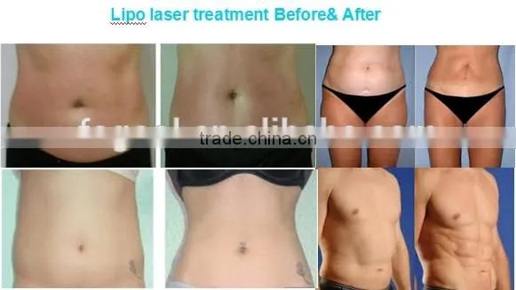 2016 Hot in USA Newest Lipo Laser 14 Pads 650nm 940nm Lipo Laser Slimming Machine for Sale / Laser Slimming Lipo Price photo-6