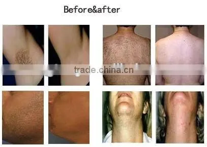 Hot Sale Acne Removal Painless Ipl Hair Removal System photo-3