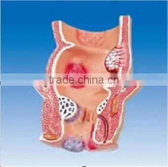 Pathological Model of Rectum