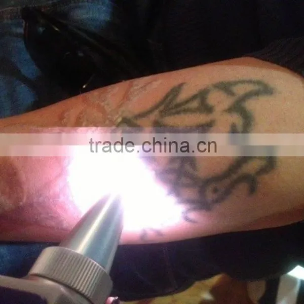Facial Veins Treatment Sanhe Professional Q Switched Nd Yag Laser/ Tattoo Removal/ Laser Tattoo Removal /nd Yag Laser Tattoo Removal Machine Haemangioma Treatment photo-5