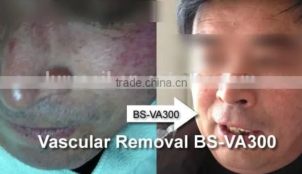 High Frequency Vascular Removal Red Spider photo-4