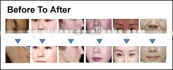 Shr Elight Permanent Laser Hair Removal Laser Tattoo Removal Beauty Instrument photo-2