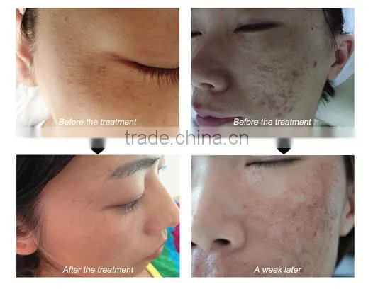 Clinic Use Fractional rf Microneedle Scar Removal Machine photo-6