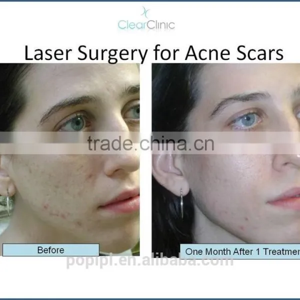 Fractional Co2 Scar Removal Laser From POP IPL photo-3