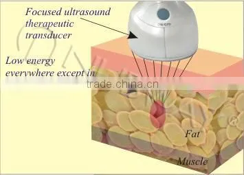 The Most Advanced Non Surgical Fat Reduction and Body Sculpting System Machine for Fat Loss photo-4