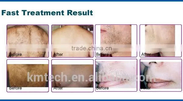 CE ISO Approved Portable Medical 808nm Diode Laser Hair Removal Machine With 160J/cm3 Energy photo-3