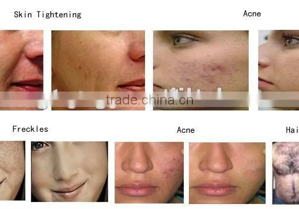 Hot Sale Acne Removal Painless Ipl Hair Removal System photo-5