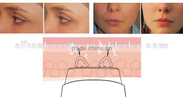 Mini rf Best rf Skin Tightening Face Lifting Machine photo-5