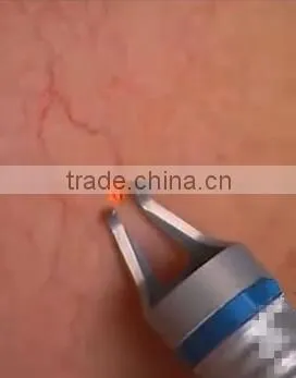 Spider Vein Removal Laser photo-5
