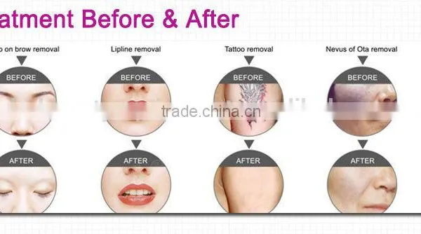 1 HZ New Professional Manufacturer Lipline Hori Naevus Removal Removal Laser Tattoo Removal Machine photo-6