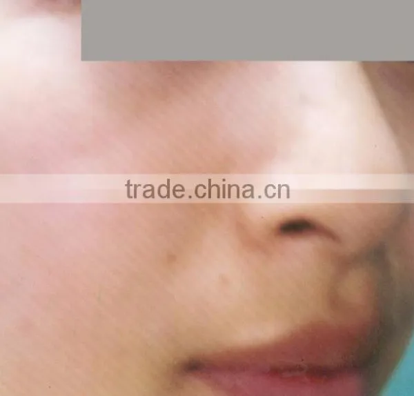Cooling Comfortable Ipl Elight Machine Hair Removal and Skin Rejuvenation System photo-5