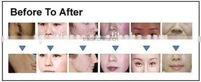 Discount Screen Logo Customized Nd Yag Laser Hair Removal Nd Yag Laser Ipl photo-4