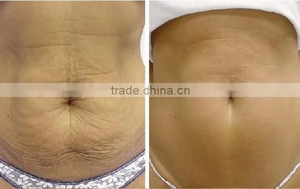 2016 Factory Machine Wholesale Radio Frequency Wrinkle Removal Face Lift Skin Rejuvenation and Acne Scar Clearance photo-6